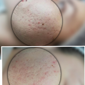 Лікування акне
                    Косметолог-ін'єкціоніст Оксана Львів