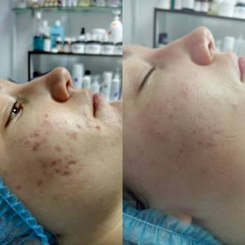 Лечение акне