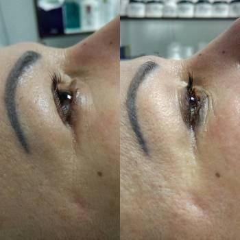 Безоперационная блефаропластика