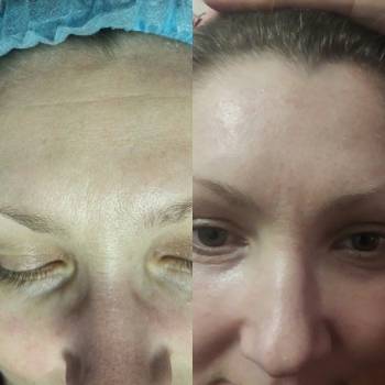 Аппарат PlasmaSkin