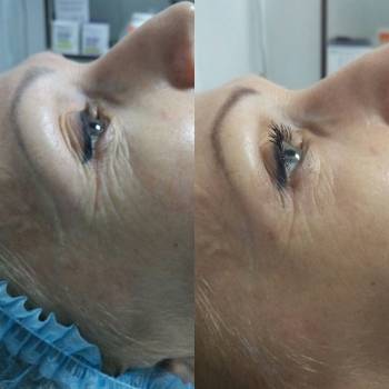 Аппарат PlasmaSkin