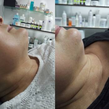 Липолитики