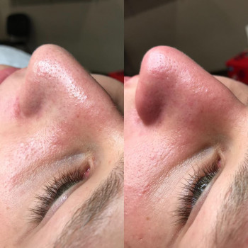 Чистка обличчя
                    Навчальний центр Hollywood Beauty Вінниця