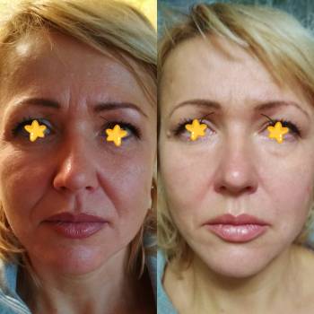 Объемное моделирование лица.Мезонити 3G от 4000грн