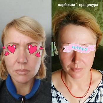 Карбокситерапия (уход)1процедура.
От 550грн