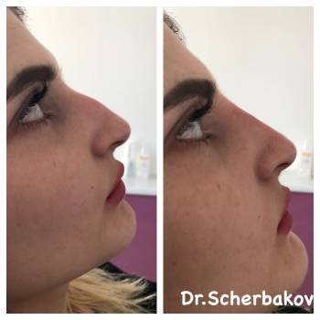 Коррекция носа с использованием препарата Neuramis Volume 1м