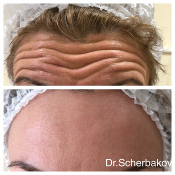 Ботокс - коррекция морщин
                    Косметологічний центр Нью Медикал Київ