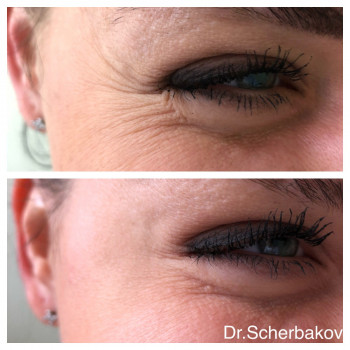 Ботокс - коррекция морщин
                    Косметологічний центр Нью Медикал Київ