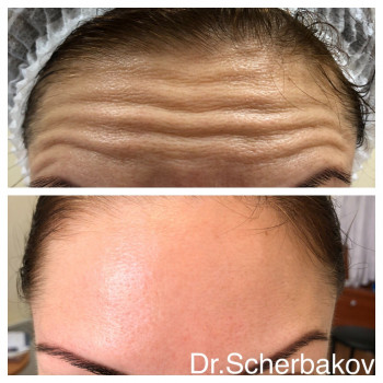 Ботокс - коррекция морщин
                    Косметологічний центр Нью Медикал Київ