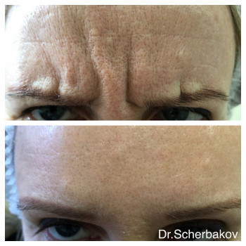 Ботокс - коррекция морщин
                    Косметологічний центр Нью Медикал Київ