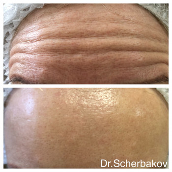 Ботокс - коррекция морщин
                    Косметологічний центр Нью Медикал Київ