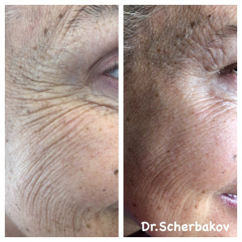 Ботокс - коррекция морщин
                    Косметологічний центр Нью Медикал Київ