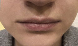 Корекція форми губ - Контурна пластика Лікар-косметолог Неля Константиновна Київ