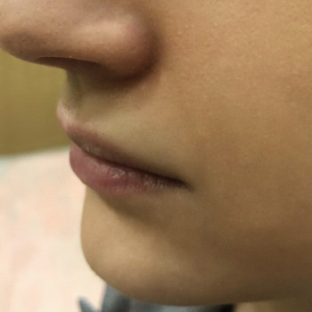 До процедуры