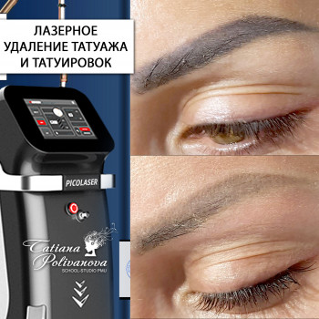 Лазерное удаление татуажа и татуировок