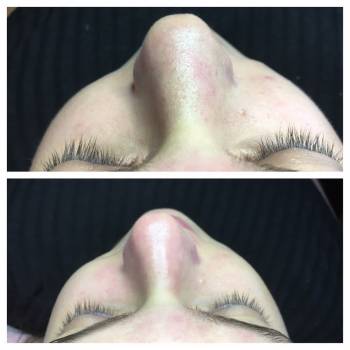 Чистка лица 