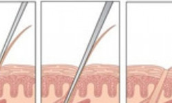 Электроэпиляция Мастер депиляции Натали Одесса
