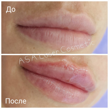 Инъекционное омоложение кожи в Киеве
                    Косметологічний центр ASA LASER COSMETIC Київ