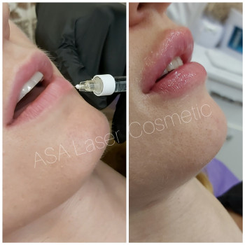 Инъекционное омоложение кожи в Киеве
                    Косметологічний центр ASA LASER COSMETIC Київ