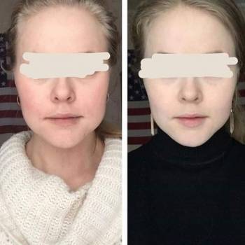 Процедура "Худое лицо"