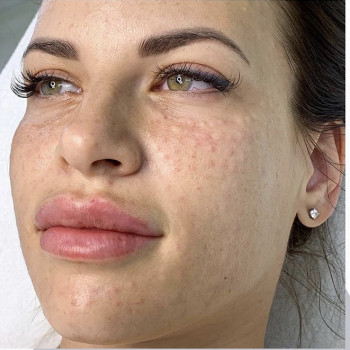 Мезотерапия
                    Косметолог Анна Гетьман Харків