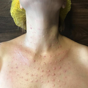 Мезотерапия
                    Косметолог Анна Гетьман Харків