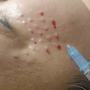 Мезотерапия
                    Косметолог Анна Гетьман Харків