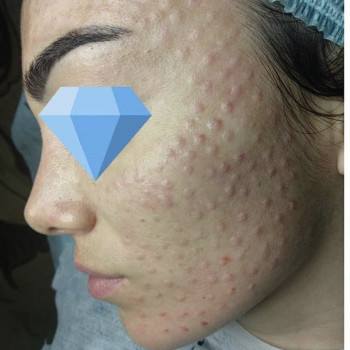 Мезотерапия
                    Косметолог Анна Гетьман Харків