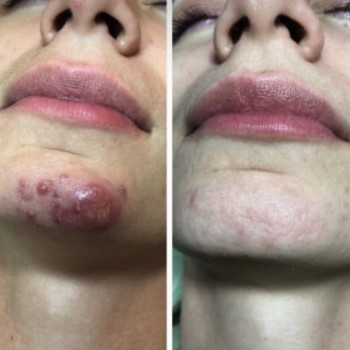 Пилинг
                    Косметолог Анна Гетьман Харків