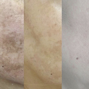 Пилинг
                    Косметолог Анна Гетьман Харків