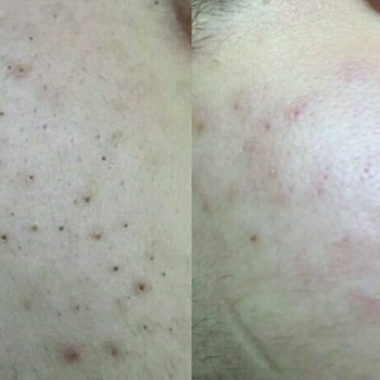 Пилинг
                    Косметолог Анна Гетьман Харків