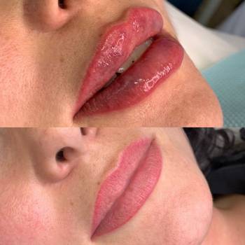 Увеличение губ. Техника "Бант"