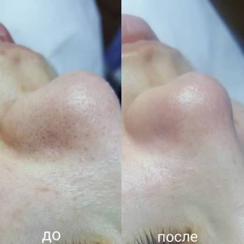 Комбинированная чистка лица.