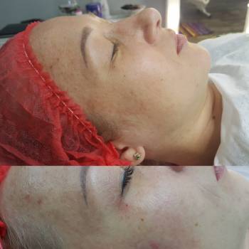 Пилинг кемикун 1 процедура.