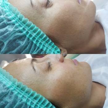 Prx-33. 1 процедура.