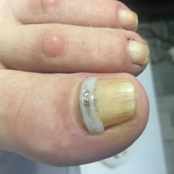 Фото из портфолио специалиста Алена Лемачко (подолог, Одесса)