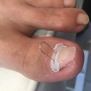 Фото из портфолио специалиста Алена Лемачко (подолог, Одесса)