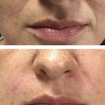 Контурная пластика носогубных складок
                    Косметолог Анна Гетьман Харків