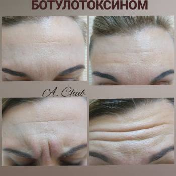 BOTULAX 
Эффект 4-6 месяцев 
Всё фото в max мимике до и че