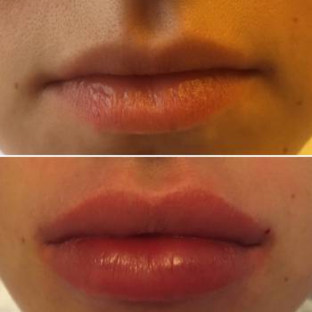 Увеличение губ