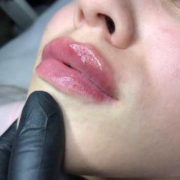 Збільшення губ
                    Косметолог Евгения Кривий Ріг