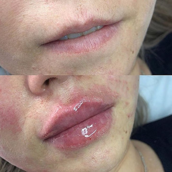 Збільшення губ
                    Косметолог Евгения Кривий Ріг