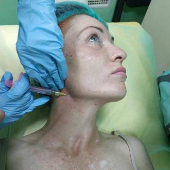 Биоревитализация.Препарат TWICE
