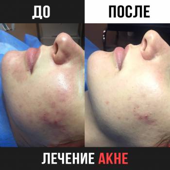Комплексное лечение акне. Результат курса.