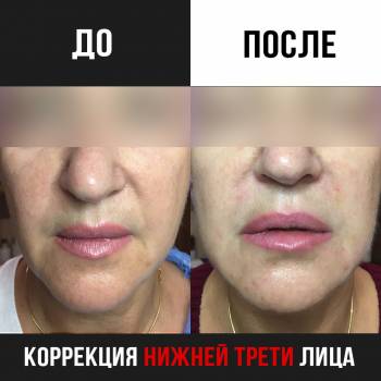 Коррекция нижней трети лица