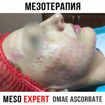 Мезотерапия препаратом Meso Expert.