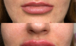 Збільшення вуст Лікар-косметолог Наталия Київ