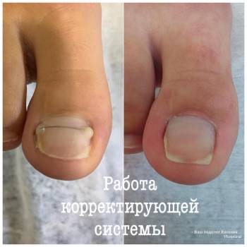 подология, вросший ноготь