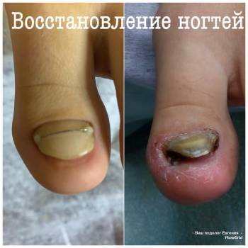 вросший ноготь, лечение ногтей на ногах