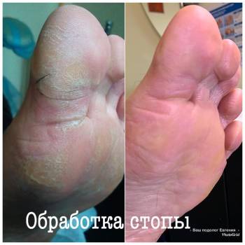 подология, чистка пятки, лечение стопы